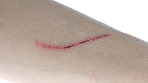 دراسة: الجروح تلتئم بوتيرة أسرع خلال