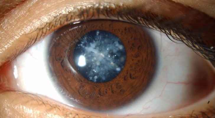 فريق جراحة عالمي يجري عمليات مجانية