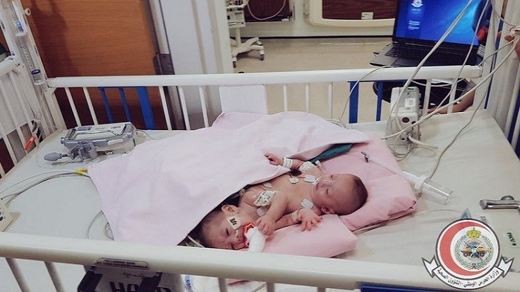 فصل توأم فلسطيني (فيديو وصور)