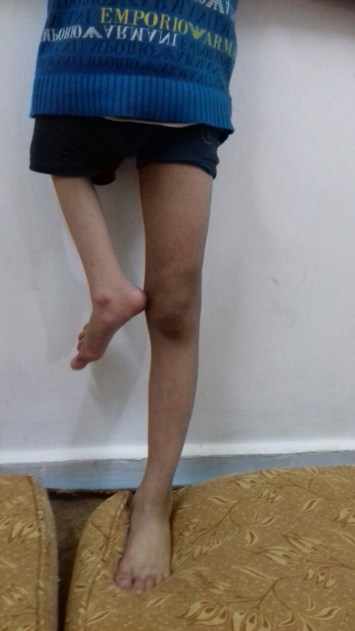 حالة صعبة لطفل أردني ولد بلا