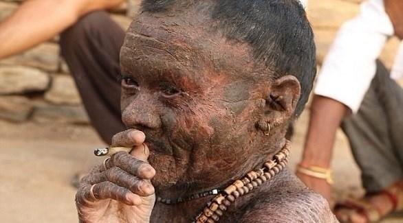 ’الرجل الأفعى‘ يبدل جلده كل 10