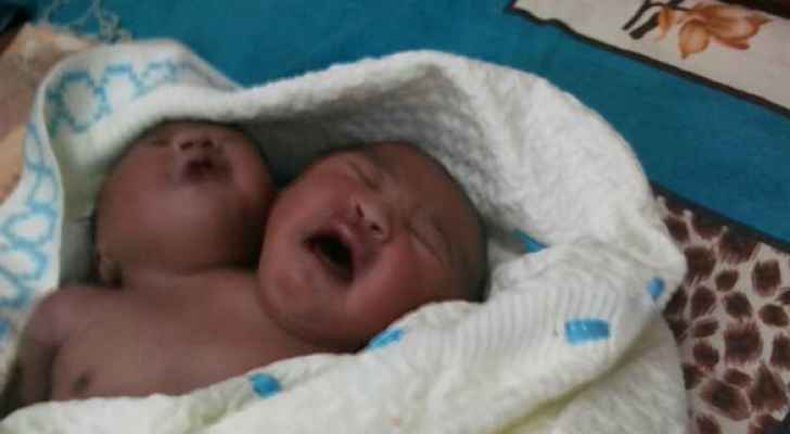 حالة نادرة في السودان.. ولادة طفل