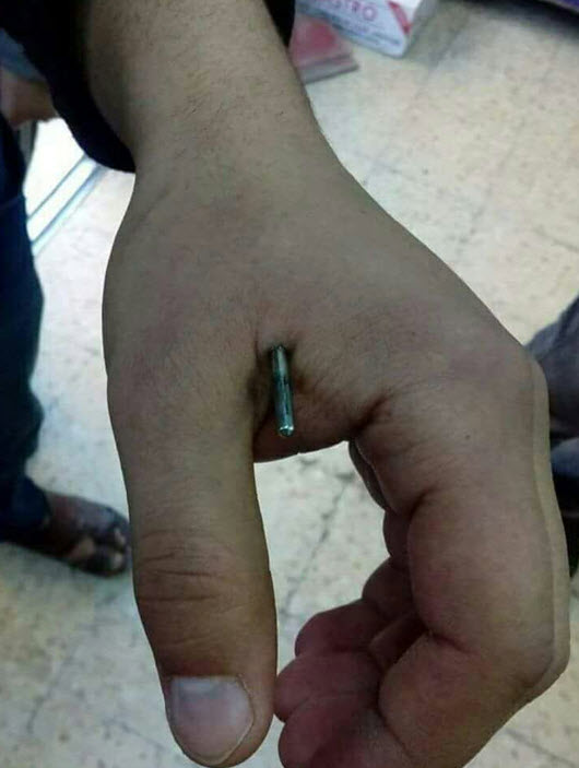 مريض يفر من مستشفى حكومي.. والسبب