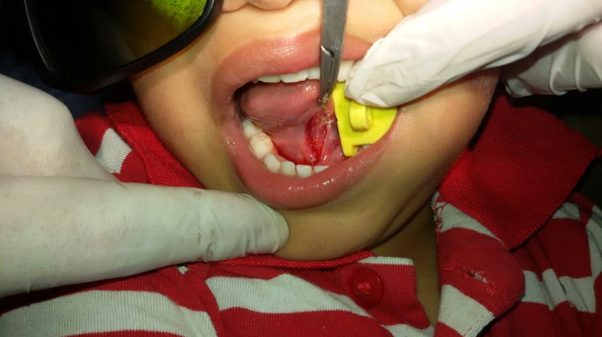 استخدام الليزر لتحرير اللسان المربوط في