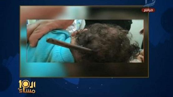 استخراج سيخ من رأس رضيع مصري