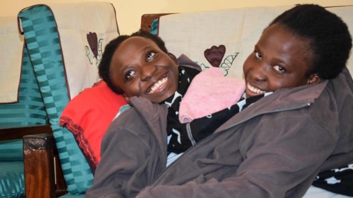 صور.. وفاة توأم ملتصق بعد تعرضه