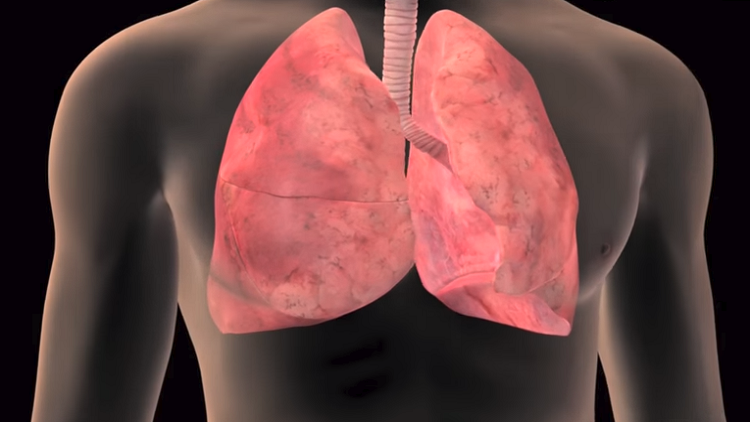لماذا يصاب غير المدخنين بسرطان الرئة؟