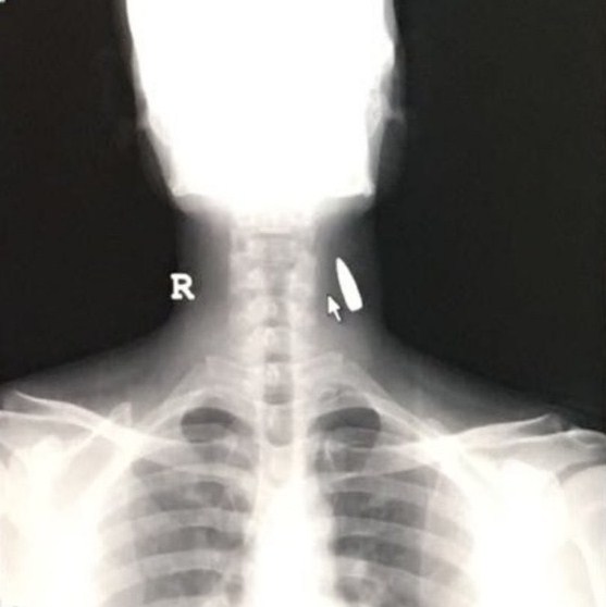 نجاة وافد هندي بالسعودية اخترقت رصاصة