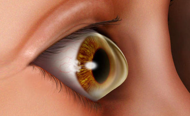 جدل في مصر بعد سرقة قرنية