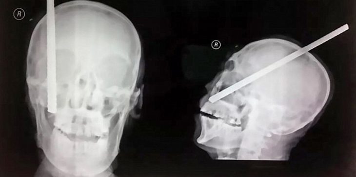 بالصور.. نجاة عامل بناء اخترق سيخ