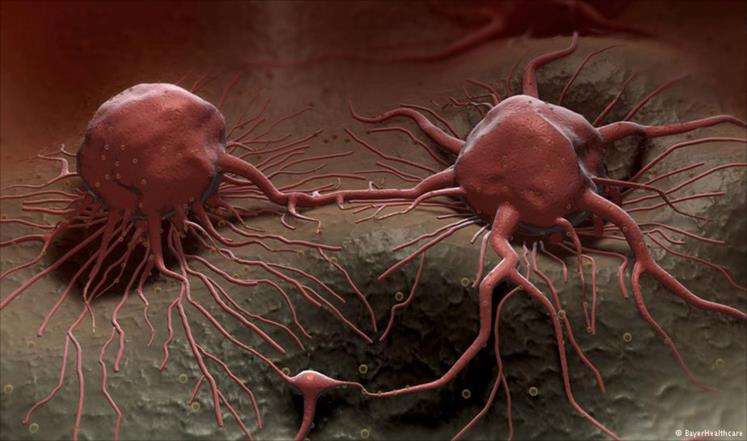 تعرف على أعراض السرطان التي تظهر