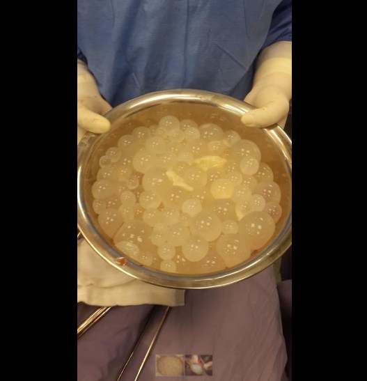 إجراء عملية إزالة أكياس كلبية في