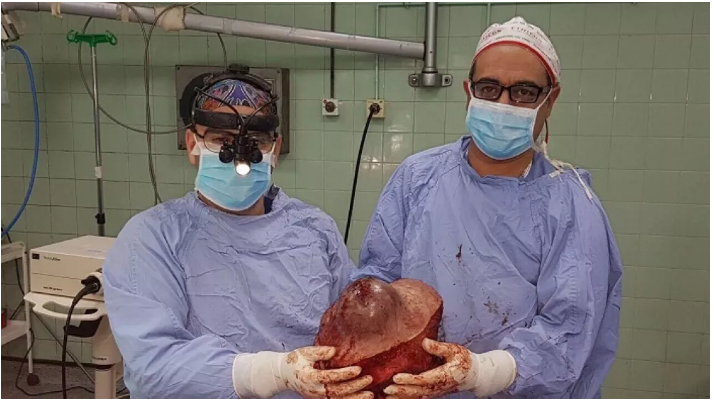 استئصال ورم بوزن 5 كيلو في