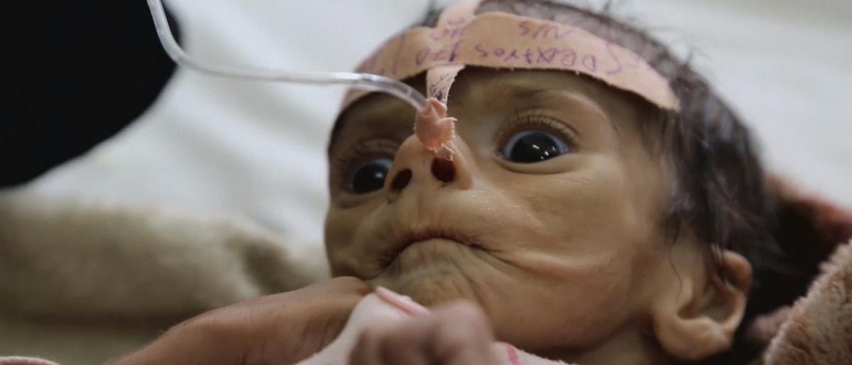 أكثر من 2 مليون طفل يمني