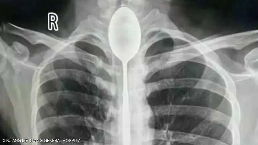 صيني ابتلع ملعقة وحدث ما لا