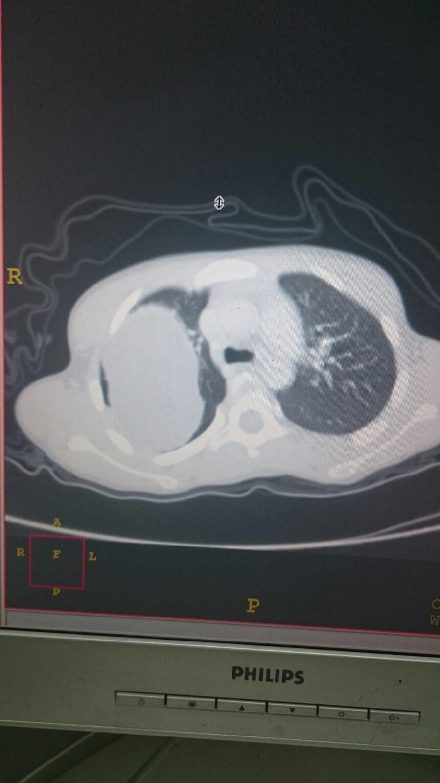 استئصال كيس بحجم كيلو غرام من