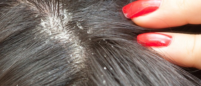 الحكومة ترفع الضريبة على شامبو القمل