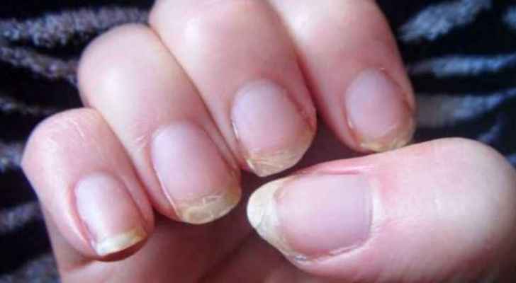أظافرك وصحتك.. 8 علامات خطيرة ’لا