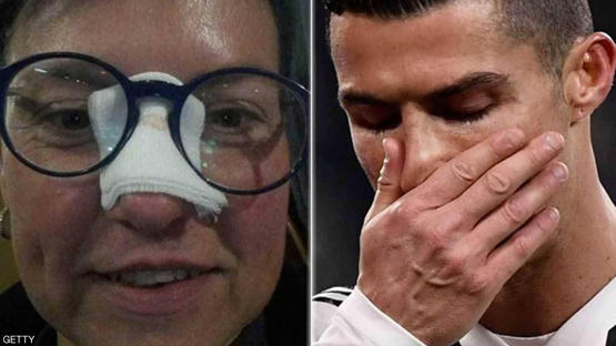 رونالدو يجبر خاطر فتاة كسر أنفها