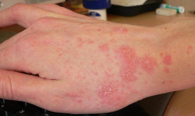 إربد: إصابة عشرات طلاب المدارس بمرض