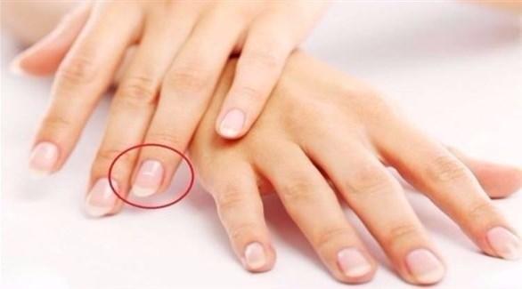سبب ظهور بقع بيضاء على الأظافر