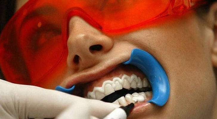 دراسة صادمة.. تبييض الأسنان أخطر مما