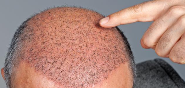 الميزات المهمة لعملية زراعة الشعر في