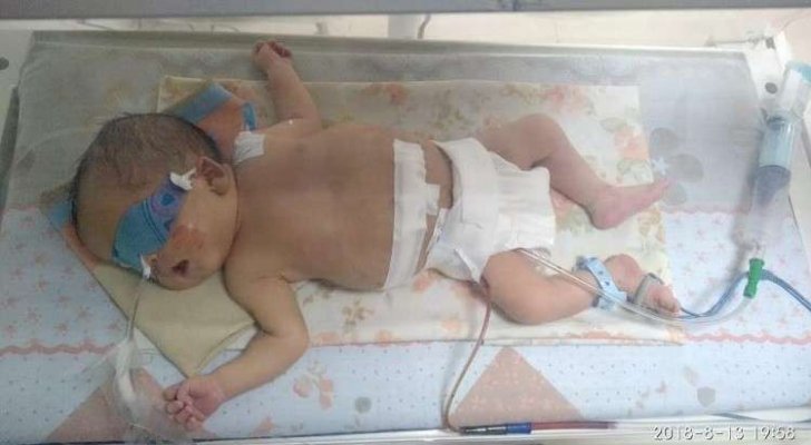 مولودة ابتلعت أختها.. جراحة نادرة في