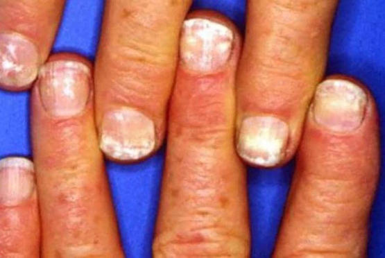 لماذا تظهر النقاط البيضاء على الأظافر؟
