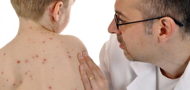 60 إصابة جديدة بالحصبة في 26