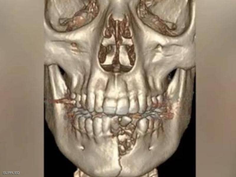 سيجارة إلكترونية تشوه وجه مراهق أميركي