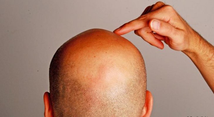 دراسة جديدة: الرجل الأصلع ناجح في