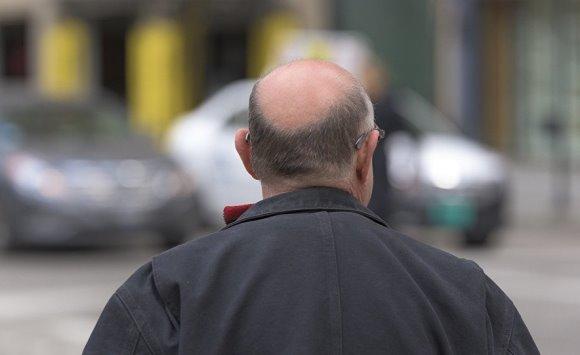 هل تعتبر زراعة الشعر حلا لمشكلة