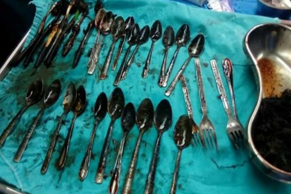 استخراج ملاعق وسلاسل ذهبية من بطن