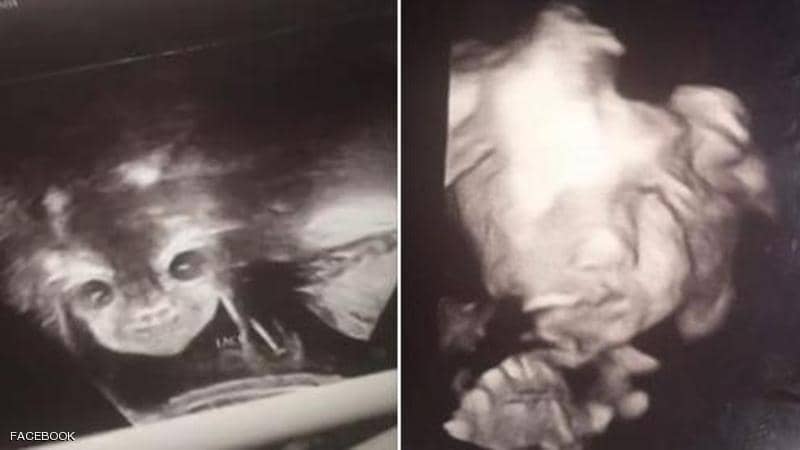 «الجنين الشيطان» يثير قلق والديه.. والطب