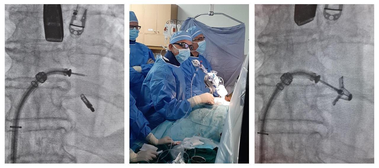 انجاز طبي بـ ’قسطرة القلب‘ في