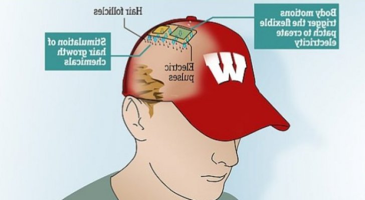 جهاز جديد لمكافحة الصلع