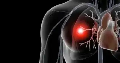 أعراض الجلطة الرئوية: إليك أكثر الفئات