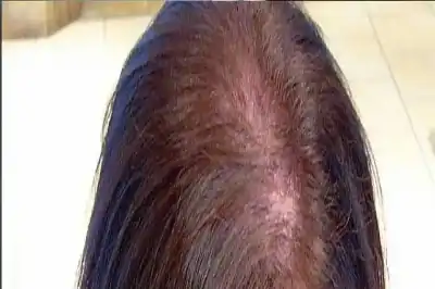 لتجنب ترقق الشعر: لماذا يحذّر الخبراء