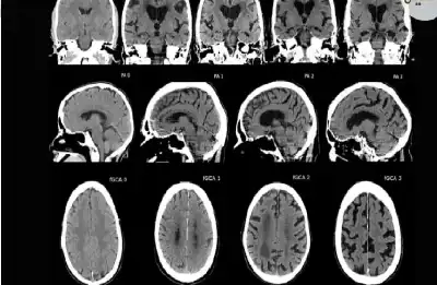 خطر الضمور المعرفي: كيف يؤدي الاعتماد