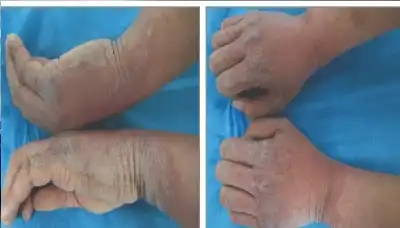 علامة اليد في الدلو.. حالة طبية