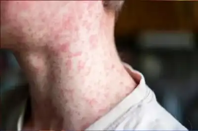 أستراليا تعلن حالة التأهب: إصابات الحصبة