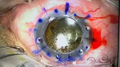 عملية نوعية لمريض في مقلة العين