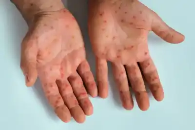حصيلة ثقيلة للحصبة في أمريكا.. آلاف