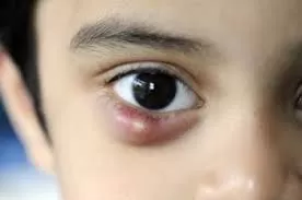 علامات شعيرة العين المؤلمة وطرق علاجها